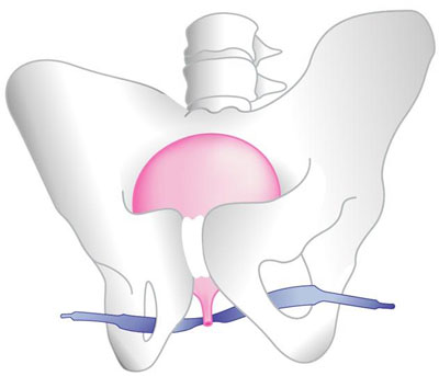 Bandelette sous urétrale pour traiter l'incontinence urinaire