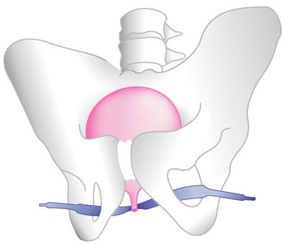 Female urinary incontinence | Dr Velemir, chirurgien gynécologue obstétricien à Nice