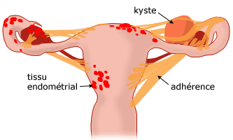 Surgery of endometriosis | Dr Velemir, chirurgien gynécologue obstétricien à Nice