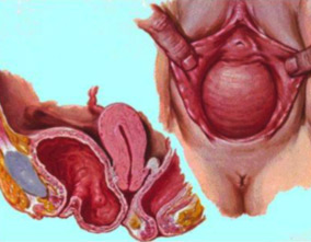 Cystocèle : descente de vessie