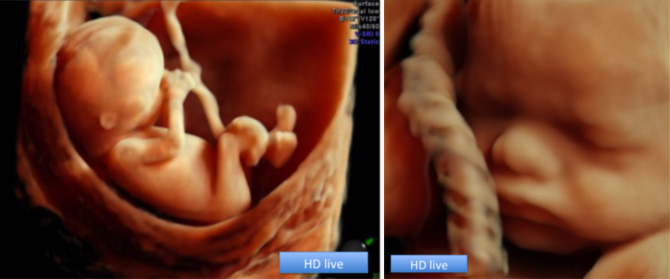Échographies obstétricales morphologiques HD live