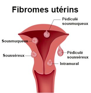 Fibrome utérins