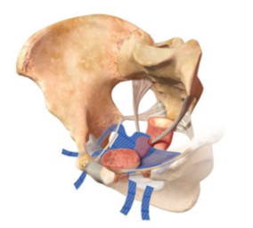 Genital prolapse cure | Dr Velemir, chirurgien gynécologue obstétricien à Nice