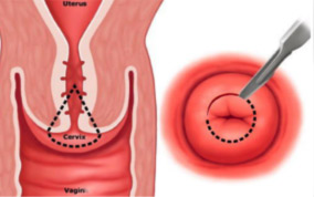 Частичное удаление шейки матки (конизация) | Dr Velemir, chirurgien gynécologue obstétricien à Nice