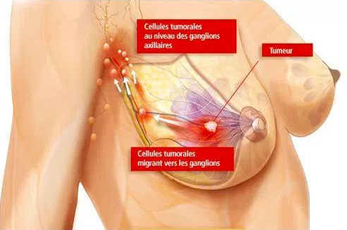 Breast cancer | Dr Velemir, chirurgien gynécologue obstétricien à Nice