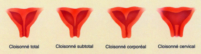 Cure de cloison utérine