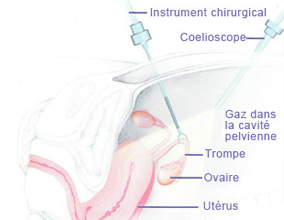 Laparoscopy in Nice | Dr Velemir, chirurgien gynécologue obstétricien à Nice