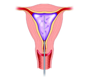 Endometrial ablation (endometrectomy) | Dr Velemir, chirurgien gynécologue obstétricien à Nice