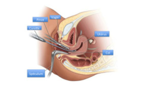 Endometrial ablation (endometrectomy) | Dr Velemir, chirurgien gynécologue obstétricien à Nice