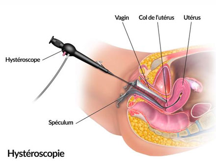 Hysteroscopy in Nice | Dr Velemir, chirurgien gynécologue obstétricien à Nice