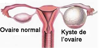 Kystes bénins de l'ovaire