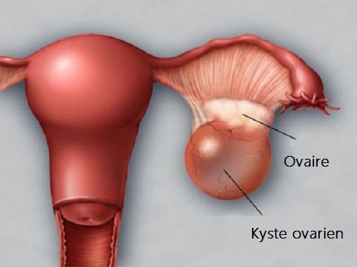 Opération kyste ovarien coelioscopie | Kystectomie chirurgie ...